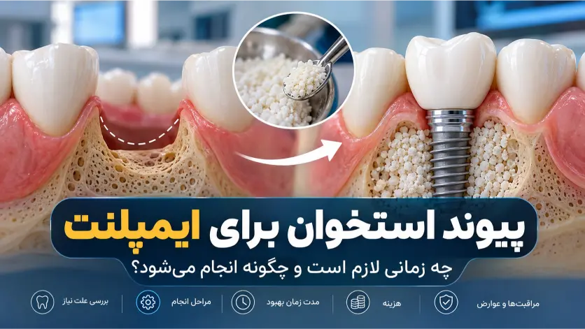 پیوند استخوان برای ایمپلنت؛ چه زمانی لازم است و چگونه انجام می شود؟